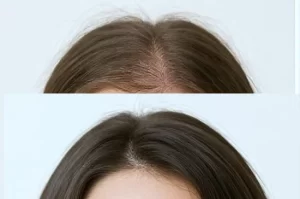 mejorar caida del pelo